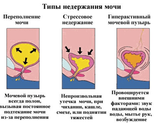 Как бороться с недержанием мочи?
