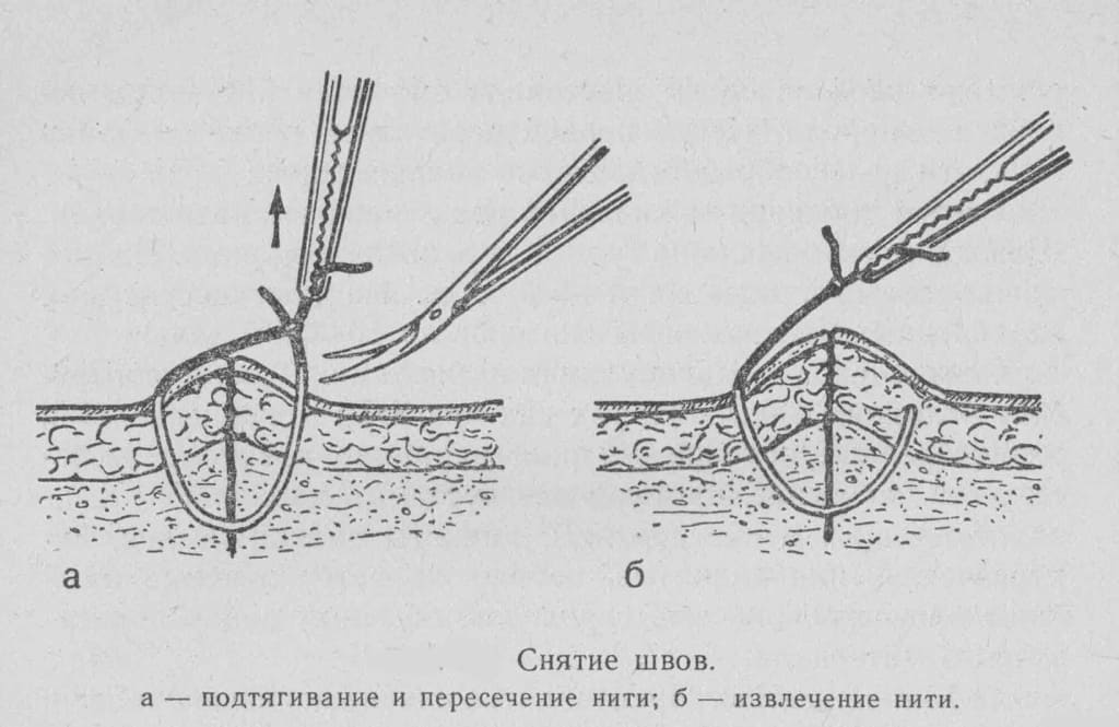 порядок действий по снятию швов